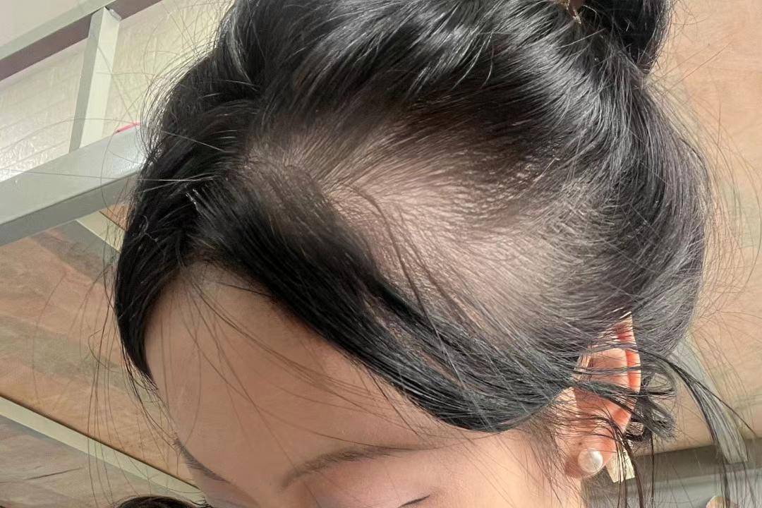 脱发上岸真谛分享！真希望所有脱发星人都刷到！分分钟发量逆袭！